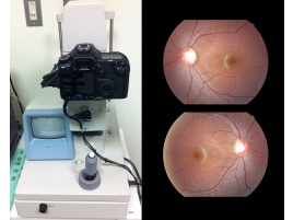 免散瞳眼底攝影檢測儀(Retinal Camera)